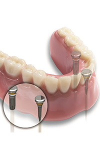 dental implants Baltimore