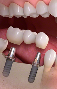 dental implants Maryland MD