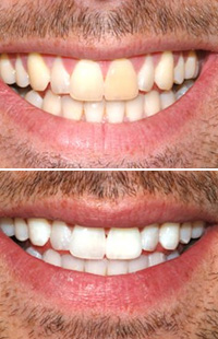 Teeth Whitening Baltimore