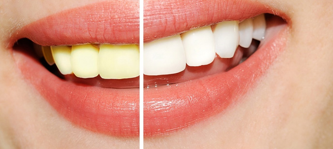 teeth whitening clinic in Baltimore