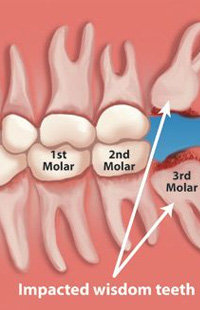 Wisdom Tooth Extraction Maryland MD