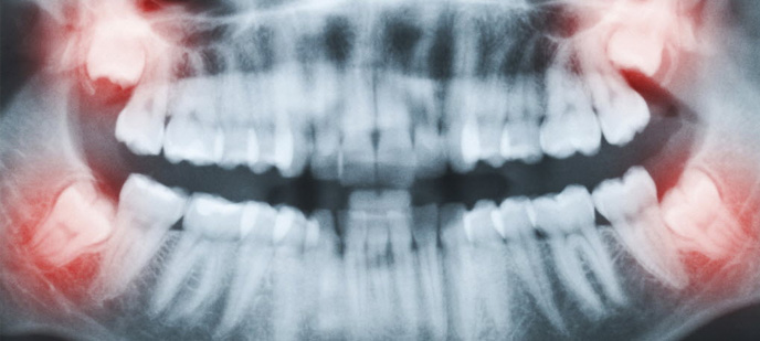 Wisdom Tooth Extraction Baltimore