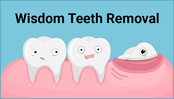 Wisdom Teeth Removal 