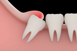 Wisdom-Teeth-Removal