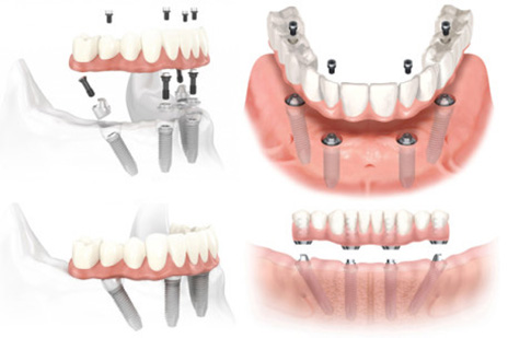 All On Four Dental Impalants treatment concept in Baltimore