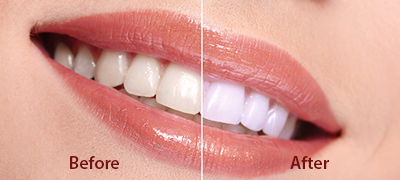 family Dental Care Before After Pictures