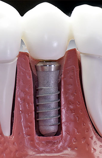 Implant dentistry Baltimore