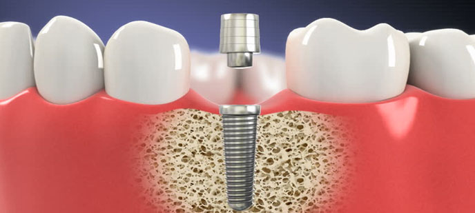 dental implants in Baltimore