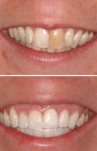 Baltimore teeth whitening